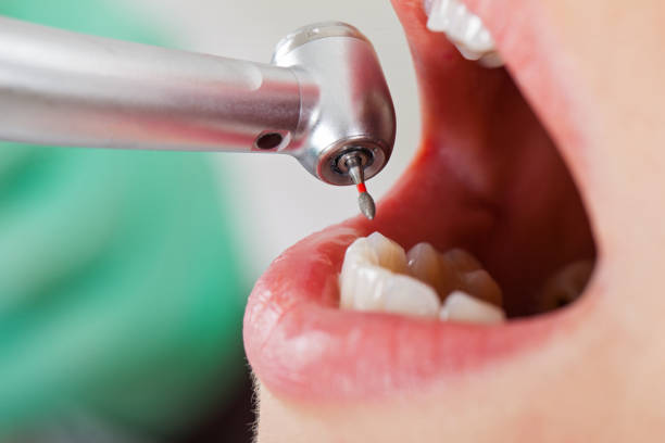 Best Emergency Wisdom Tooth Extraction in Jefferson, NC